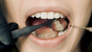 denti Disturbi Alimentari